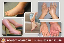 Nguyên nhân và cách chữa phù nề tay chân | Phòng khám đa khoa Hoàn Cầu