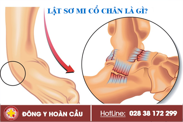 Lật sơ mi cổ chân là gì? Có nguy hiểm không? | Phòng khám đa khoa Hoàn Cầu