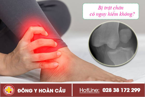 Bị trật chân có nguy hiểm không phải làm thế nào để khắc phục? | Phòng khám đa khoa Hoàn Cầu