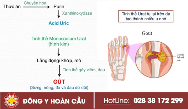 Chẩn Đoán Bệnh Gout