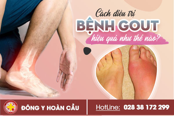 Cách điều trị bệnh gout hiệu quả như thể nào? | Phòng khám đa khoa Hoàn Cầu