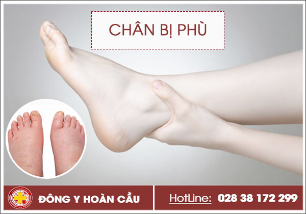 Chân bị phù là bệnh gì? Triệu chứng và cách điều trị hiệu quả | Phòng khám đa khoa Hoàn Cầu