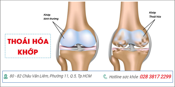 Chuột rút chân: dấu hiệu cảnh báo nhiều điều về sức khỏe | Phòng khám đa khoa Hoàn Cầu