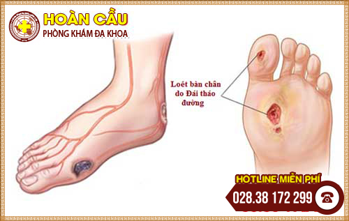 Bệnh thần kinh do tiểu đường gây nên