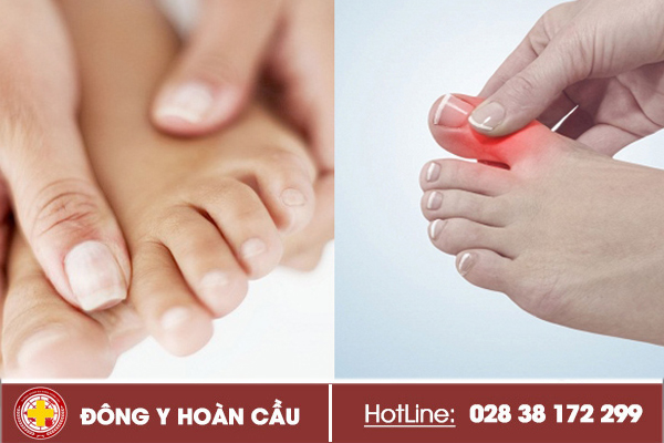 Đau khớp ngón cái chân – Triệu chứng cảnh báo bệnh gout | Phòng khám đa khoa Hoàn Cầu