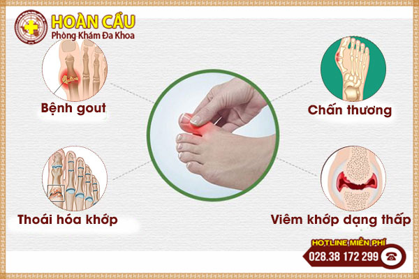 Đau khớp ngón chân cái có phải dấu hiệu của bệnh gout không? | Phòng khám đa khoa Hoàn Cầu