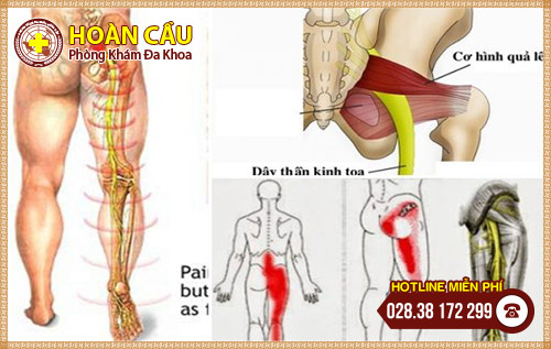 Điều trị đau thần kinh tọa khoảng bao nhiêu tiền ?