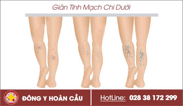 Nhận biết giãn tĩnh mạch chi dưới qua các triệu chứng điển hình | Phòng khám đa khoa Hoàn Cầu