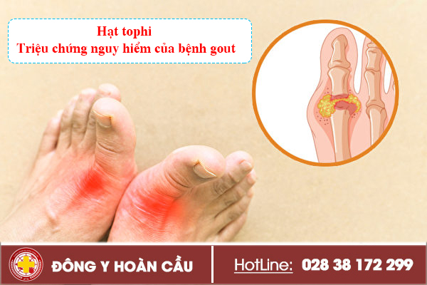 Hạt tophi - triệu chứng nguy hiểm của bệnh gout | Phòng khám đa khoa Hoàn Cầu