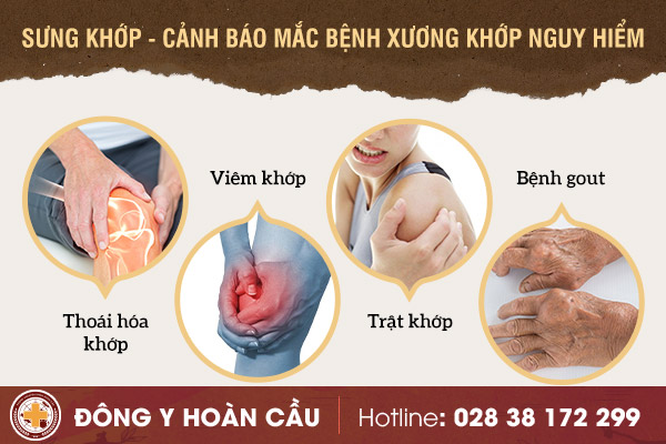 Sưng khớp - cảnh báo mắc bệnh xương khớp nguy hiểm | Phòng khám đa khoa Hoàn Cầu