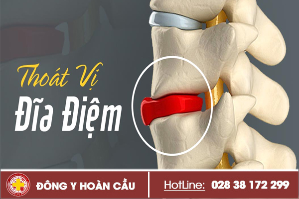 Triệu chứng thoát vị đĩa đệm như thế nào? | Phòng khám đa khoa Hoàn Cầu