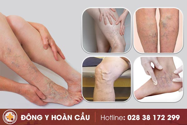 Tổng quan về bệnh giãn tĩnh mạch chân | Phòng khám đa khoa Hoàn Cầu