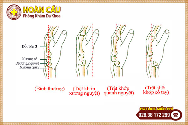 Nhận biết dấu hiệu trật khớp cổ tay và hướng điều trị hiệu quả | Phòng khám đa khoa Hoàn Cầu