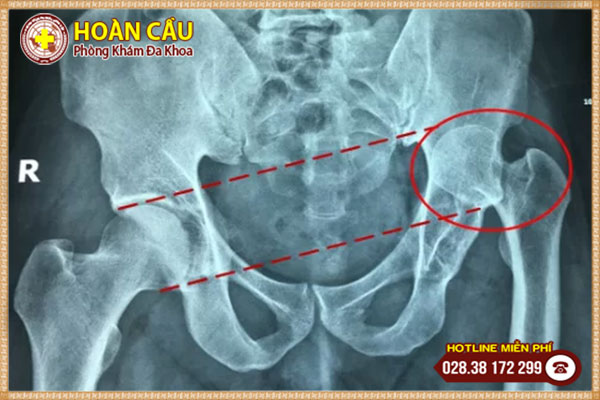 Nguyên nhân trật khớp háng và cách điều trị các chuyên gia khuyên dùng | Phòng khám đa khoa Hoàn Cầu