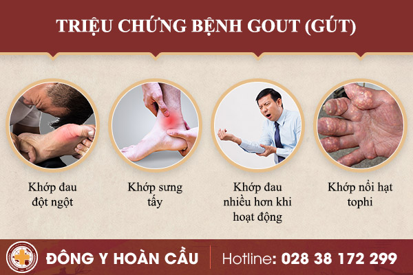Triệu chứng bệnh gout (gút) không nên bỏ qua | Phòng khám đa khoa Hoàn Cầu