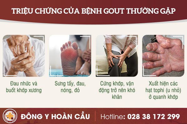 Triệu chứng của bệnh gout và cách điều trị hiệu quả hiện nay | Phòng khám đa khoa Hoàn Cầu