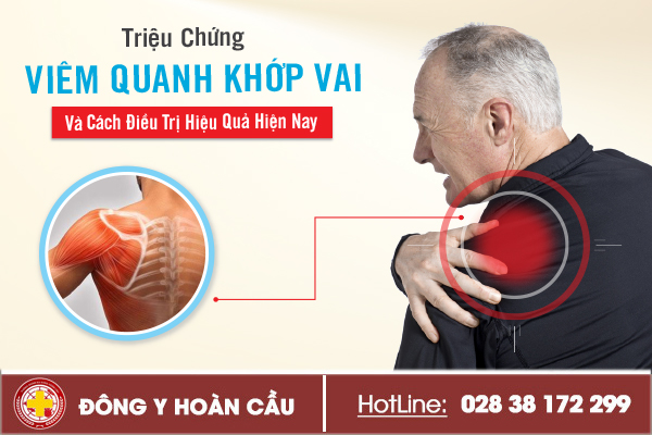 Triệu chứng viêm quanh khớp vai và cách điều trị hiệu quả hiện nay | Phòng khám đa khoa Hoàn Cầu