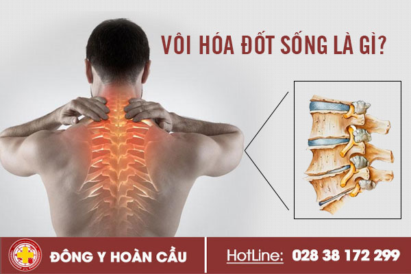 Vôi hóa đốt sống là bệnh gì? | Phòng khám đa khoa Hoàn Cầu