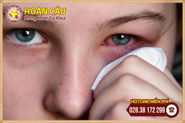 Tìm hiểu bệnh zona ở mắt để phòng tránh nguy cơ mù lòa